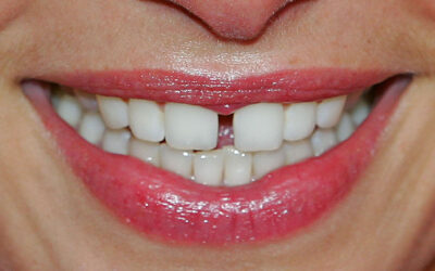 Що означає щілина між зубами: причини виникнення та способи корекції