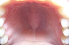 Шишка на небі в роті – причини виникнення, методи діагностики та лікування