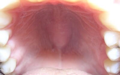 Шишка на небі в роті – причини виникнення, методи діагностики та лікування