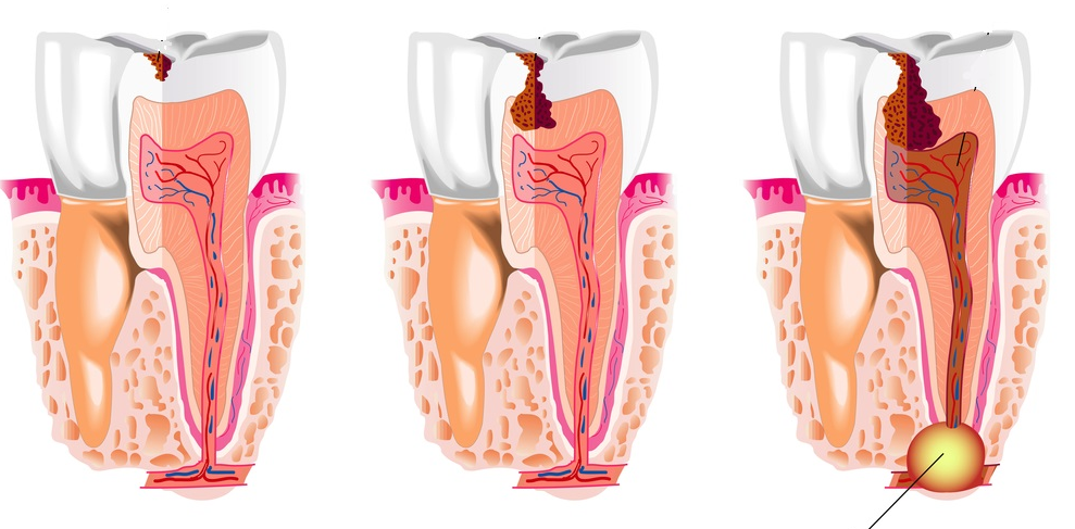 Абсцес зуба: причини виникнення, симптоми і способи лікування