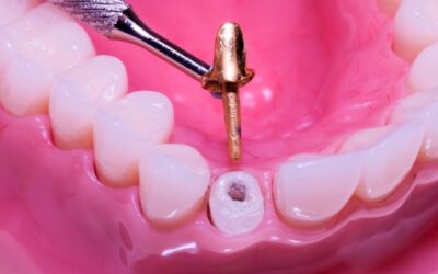 Що таке титановий штифт в зубі – призначення і застосування в стоматології