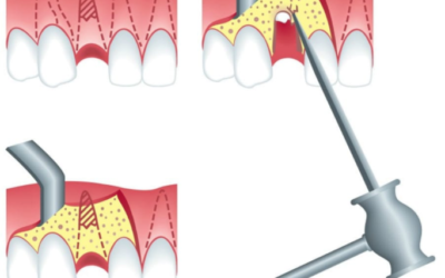 Як відбувається видалення кореня зуба: особливості та методи проведення операції
