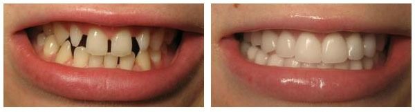 Рідкі зуби: небезпека такої аномалії і методи її лікування