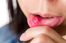 Чим лікувати виразки в роті: причини появи та ефективні методи позбавлення