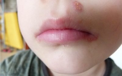 Болячки на губах у дитини: причини, симптоми і методи лікування