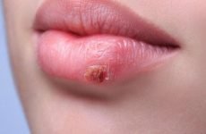 Болячки на губах: причини виникнення та методи лікування