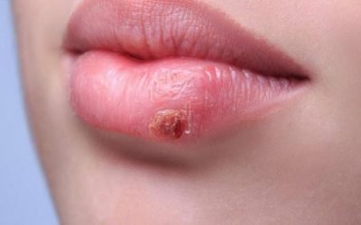 Болячки на губах: причини виникнення та методи лікування