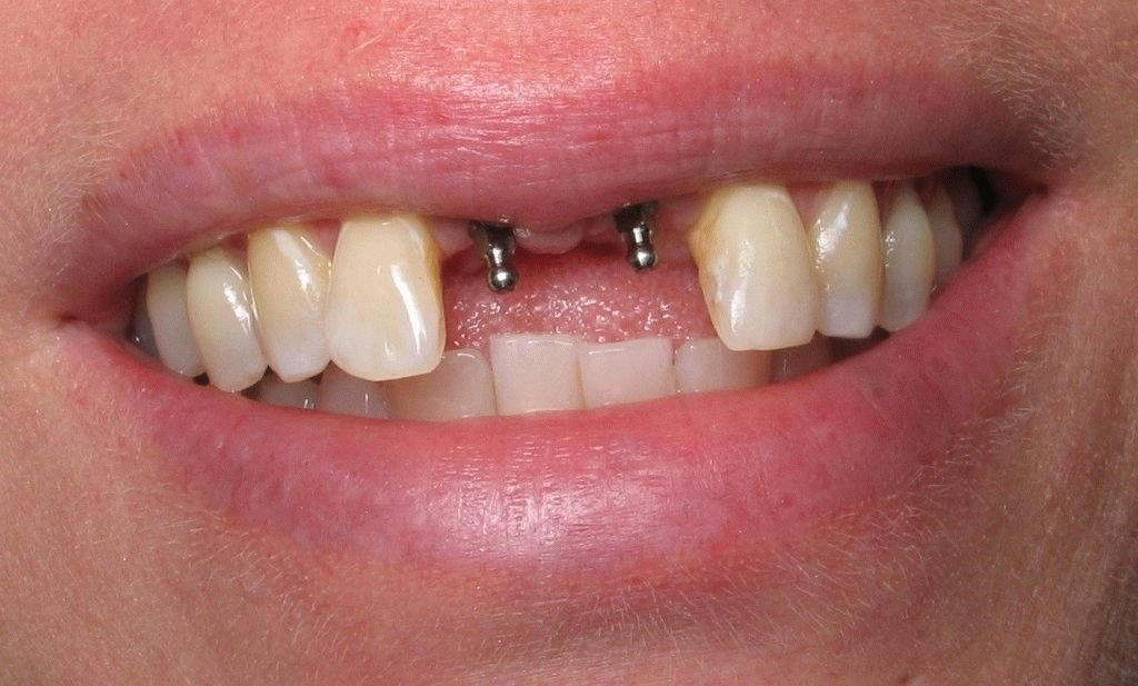 Міні імпланти зубів: коли використовуються, їх переваги і ціна