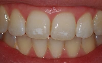 Білі плями на зубах у дорослих: причини появи та правила лікування