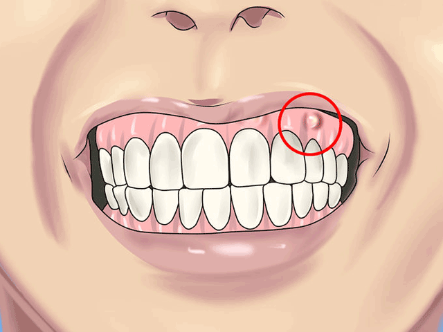 Абсцес зуба: причини виникнення, симптоми і способи лікування