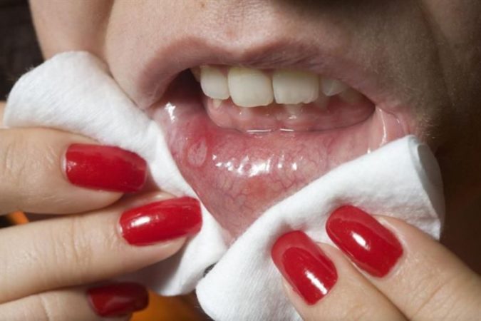 Стоматит на губі: правильна діагностика і лікування