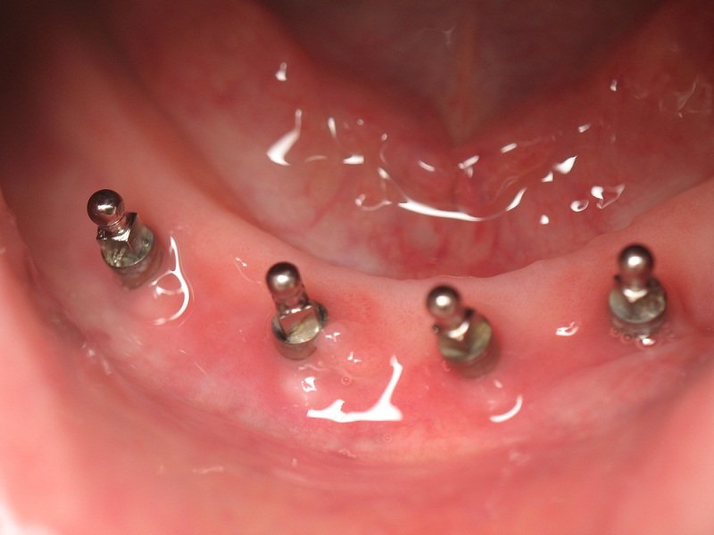 Міні імпланти зубів: коли використовуються, їх переваги і ціна