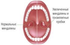 Як вилікувати тонзилитные пробки в горлі?