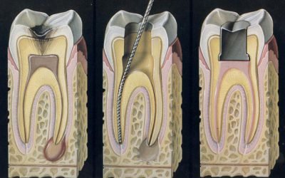 Болить нерв в зубі: що робити і як зняти біль в домашніх умовах