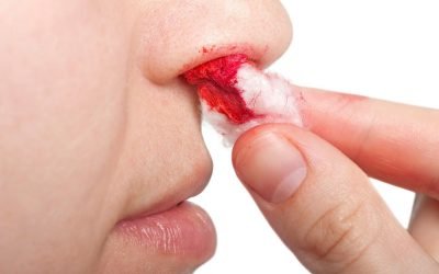 Причини виникнення кровотечі з носових ходів