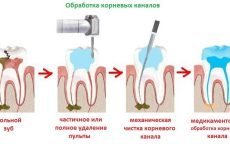 Видалення нерва з зуба – як видаляють і в яких випадках без цього не обійтися