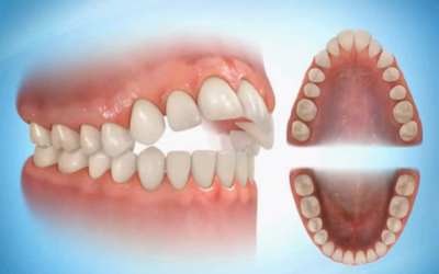 Передні зуби випирають вперед: причини дефекту і методи корекції