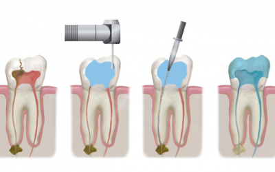 Лікування каналів зуба: етапи, методи та можливі ускладнення