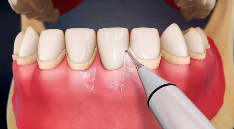 Що таке ультразвукова чистка зубів: переваги і недоліки процедури