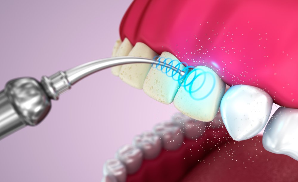 Зубний наліт   як позбутися в домашніх умовах і ефективно очистити зуби
