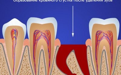 Болять сусідні зуби після видалення зуба: причини і що робити?