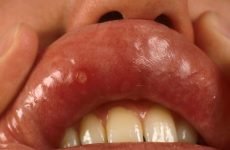 Герпес в роті у дорослих: причини, симптоми і методи лікування