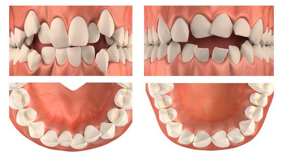 Показання до видалення зуба   коли виникає необхідність видалення