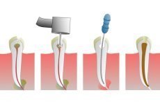 Боляче видаляти нерв зуба: особливості операції