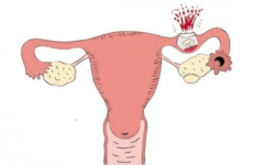 Чи можна завагітніти після позаматкової вагітності з однією трубою: як завагітніти з однією лівою або правою трубою