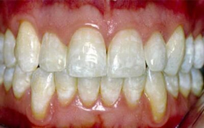 Що таке флюороз зубів – причини виникнення і методи лікування