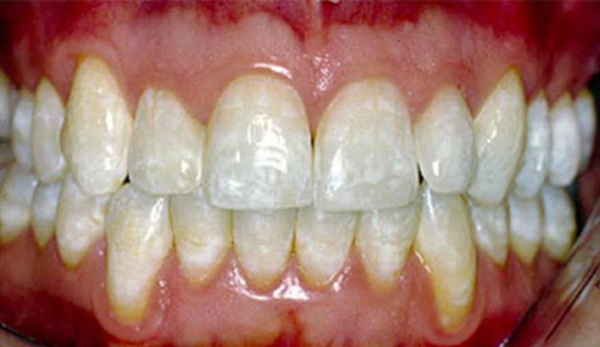 Що таке флюороз зубів   причини виникнення і методи лікування