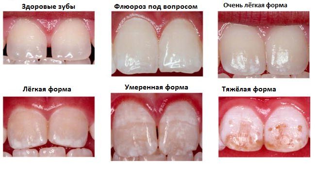 Фторування зубів: що це таке і навіщо потрібна дана процедура?