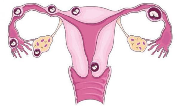 Позаматкова вагітність: симптоми і ознаки на ранніх термінах, як діагностувати патологію до затримки, 1, 4, 5 тижнів вагітності