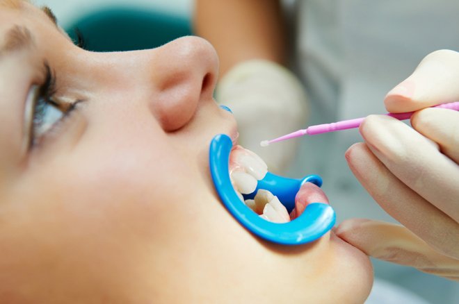 Сріблення зубів у дітей   переваги і недоліки методу