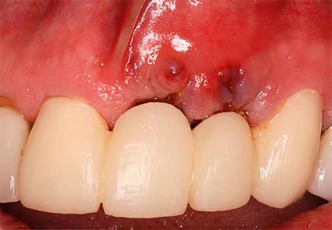 Набряк після імплантації зубів: як зняти і що робити?