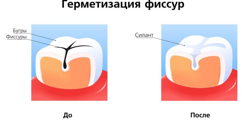 Що таке фиссура зуба: особливості процедури