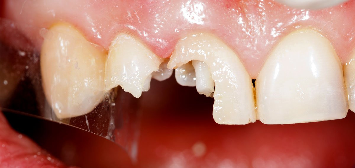 Травми зубів   класифікація, симптоми і методи ефективного лікування