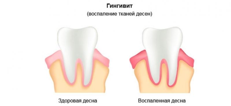 gingivit 4.jpg.jpg.jpg.jpg