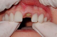 Гній після видалення зуба: причини, ускладнення та способи лікування
