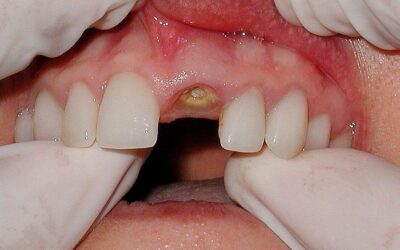 Гній після видалення зуба: причини, ускладнення та способи лікування