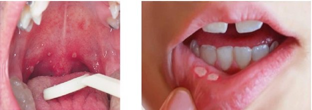 Стоматит після видалення зуба: симптоми, причини і методи лікування
