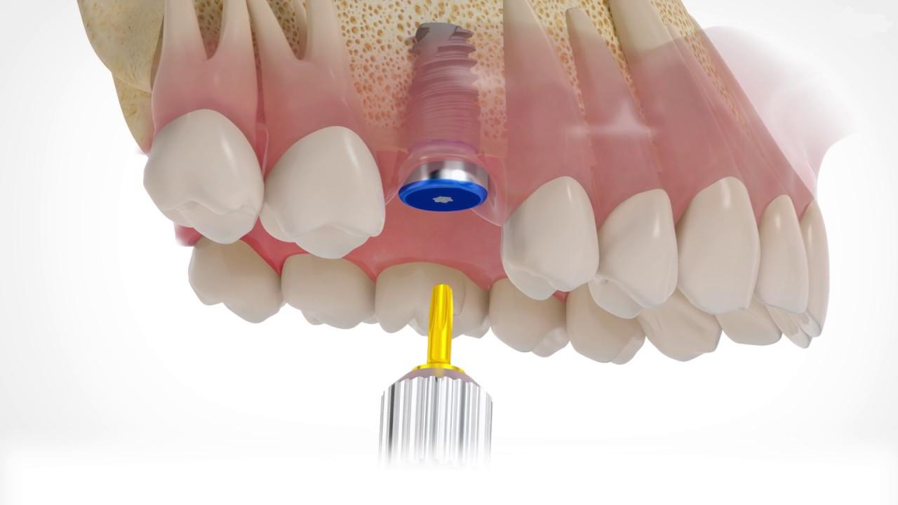 Встановлення імпланта після видалення зуба: коли можна ставити?