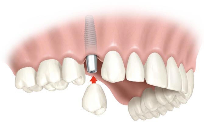 Перелом зуба: причини, симптоми і методи ефективного лікування