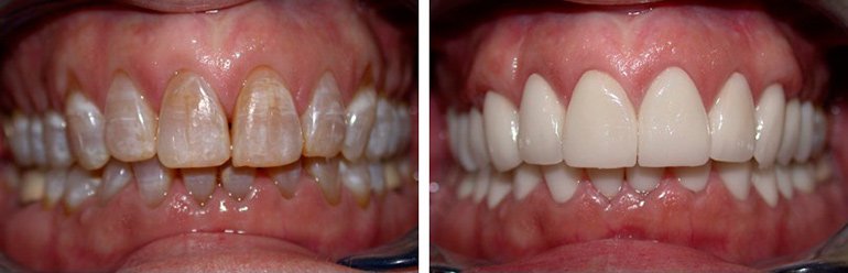 Чому зуби стають прозорими: причини і методи лікування