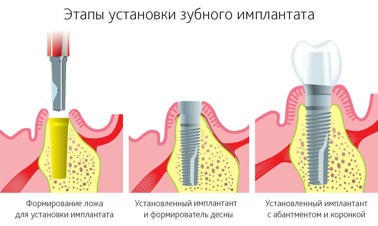 Чи боляче вставляти імплант зуба в десну?