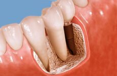 Імплантація зубів без розрізу десни: чи це можливо?
