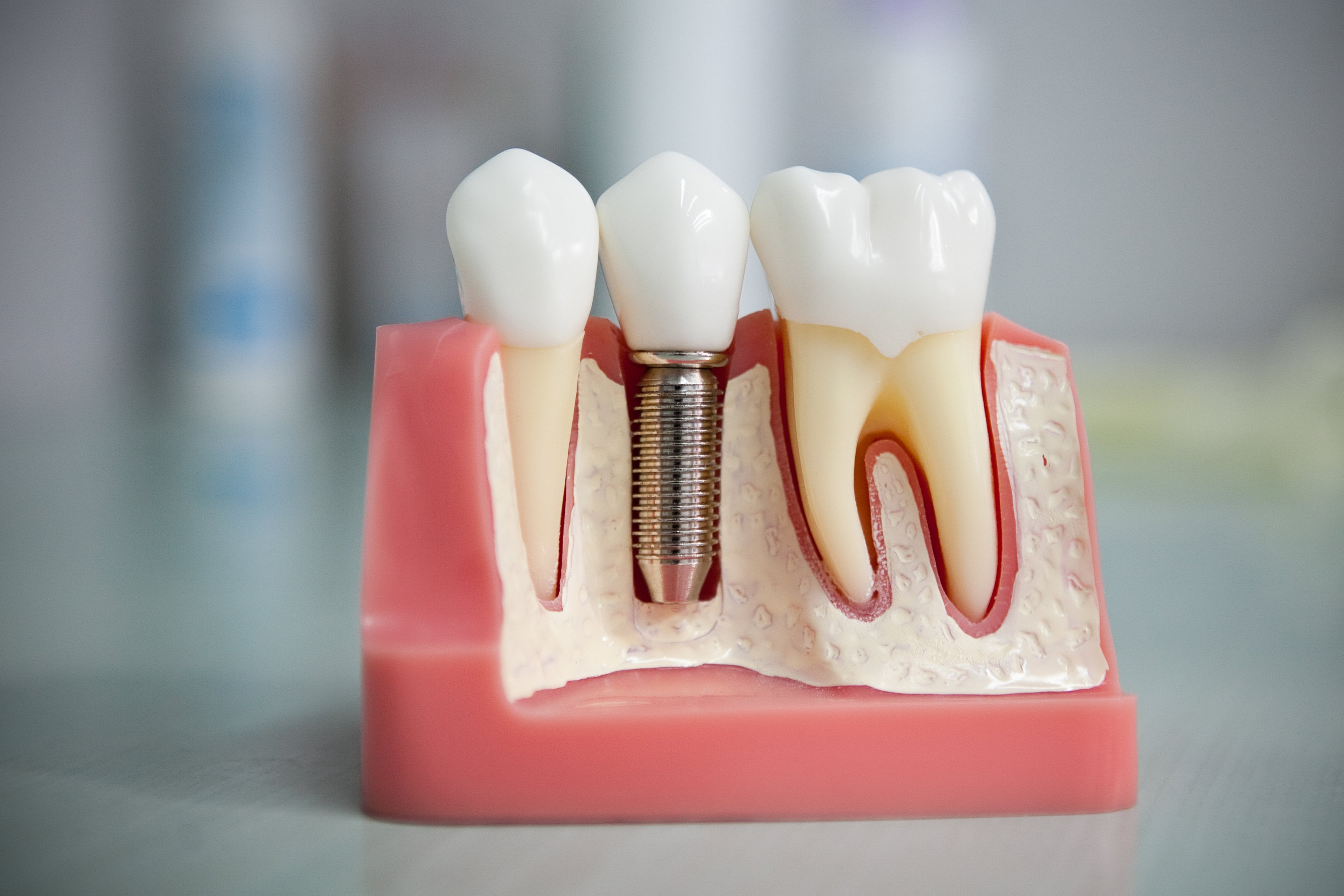 Імплантація зубів   види імплантації, ускладнення і протипоказання