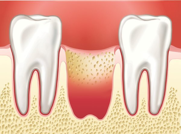 Знеболююче після видалення зуба   найефективніші засоби