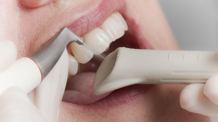 Ультразвукова чистка зубів при вагітності: показання та протипоказання до проведення