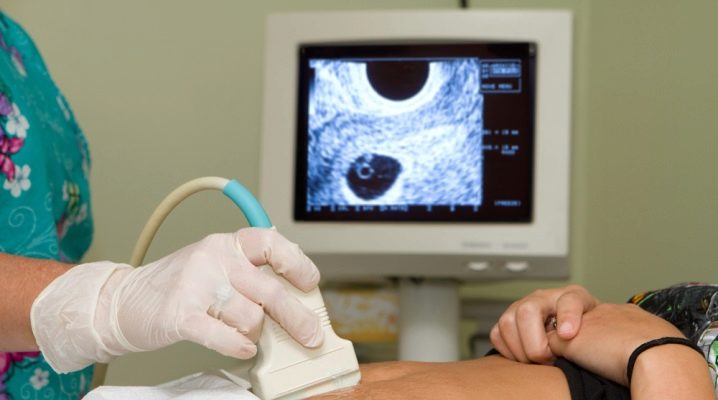 УЗД на ранніх термінах вагітності (22 фото): як часто можна робити, що перший покаже і шкідливо чи ні